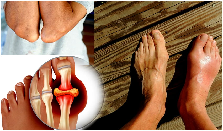 Uric Acid cause Gout : Uric Acid cause Gout Disease Infected from Food 