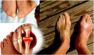 Uric Acid cause Gout : Uric Acid cause Gout Disease Infected from Food 