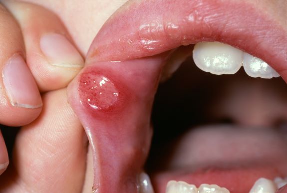 health-tips-for-mouth-ulcer-problems