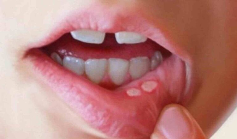 health-tips-for-mouth-ulcer-problems