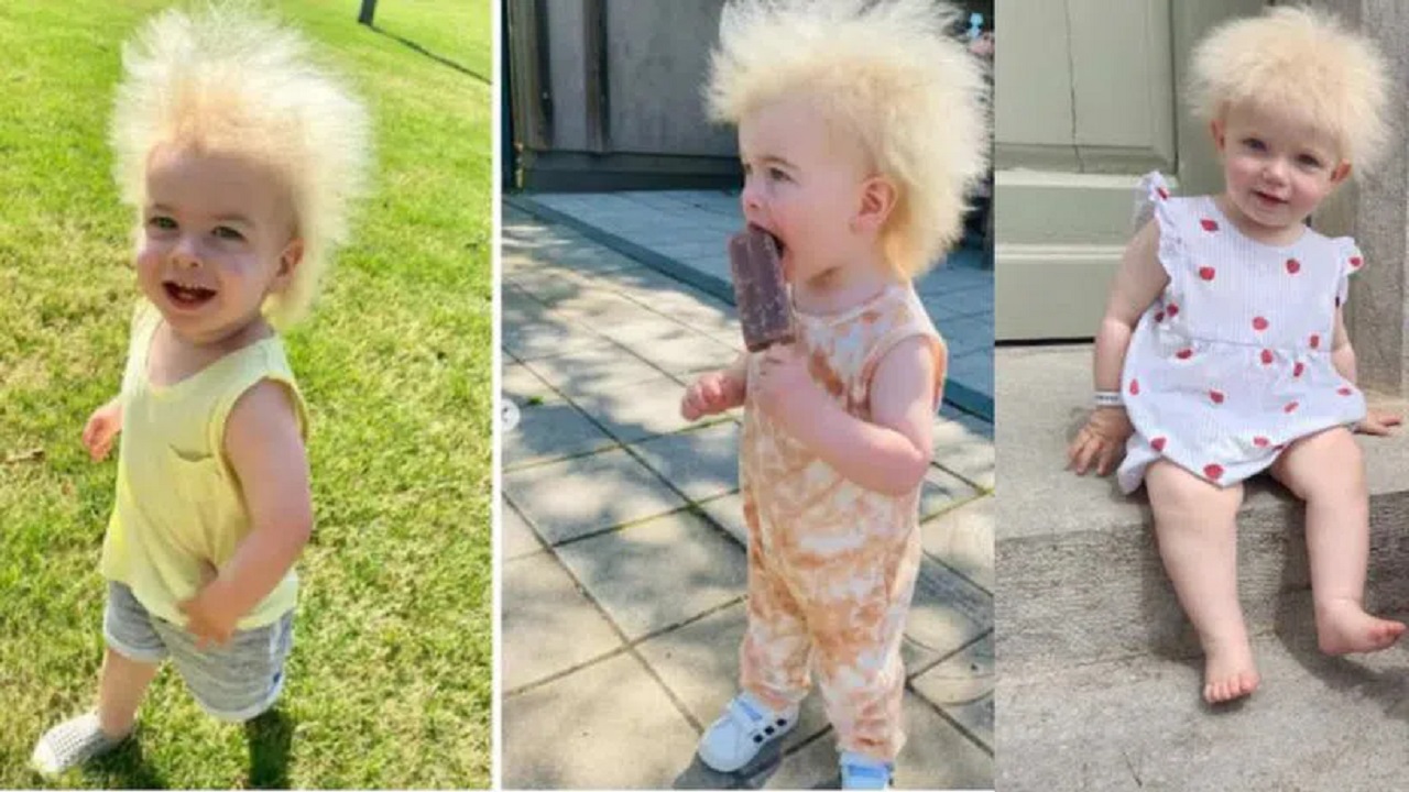 This babt is one of only 100 people in the world with uncombable hair syndome