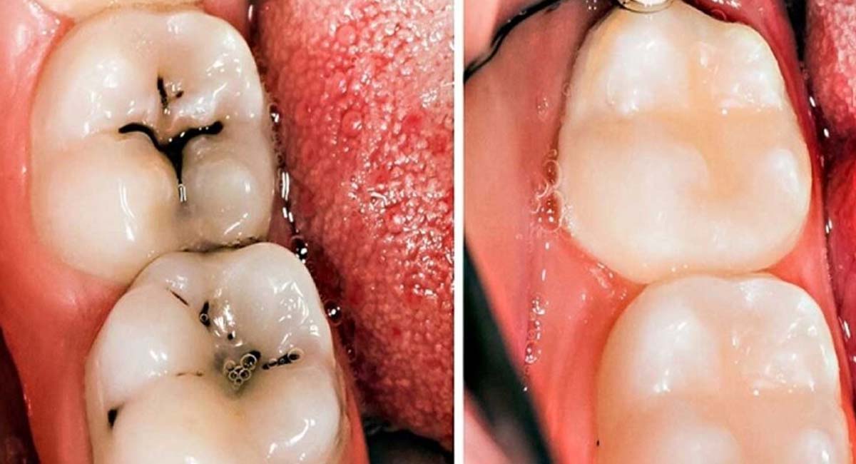 home-remedies-if-you-follow-these-tips-even-rotten-teeth-will-shine-like-pearls