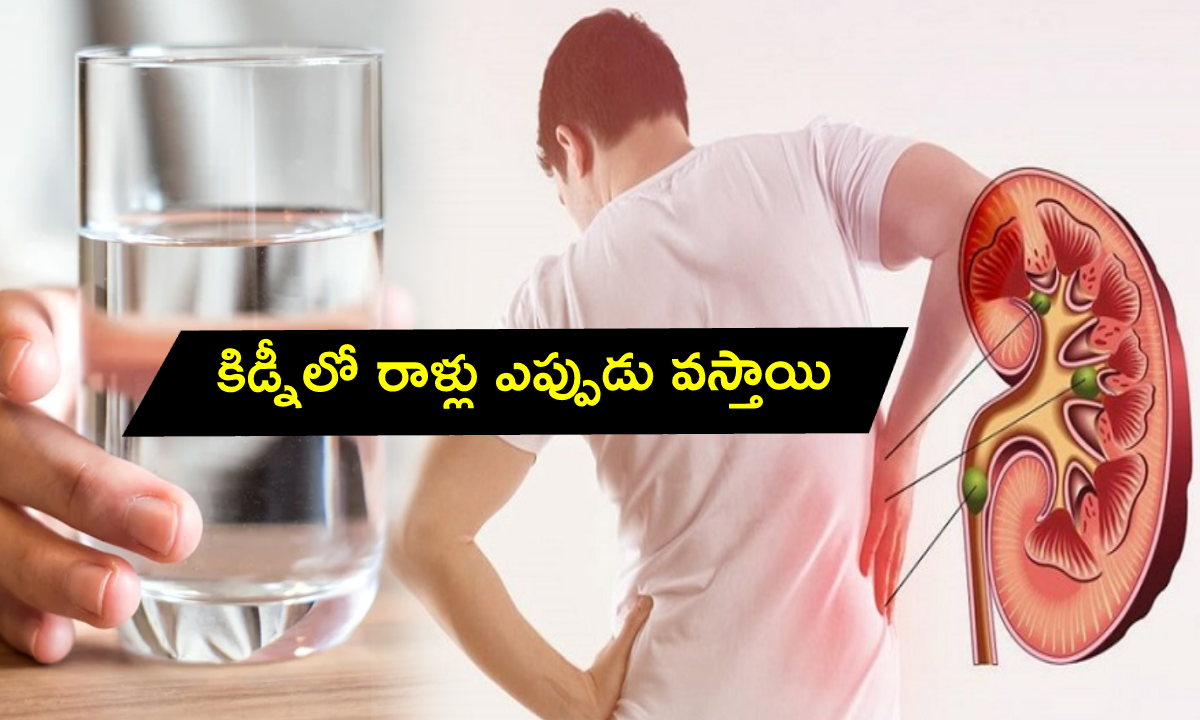 How much water to drink to avoid kidney stones