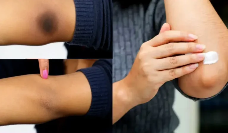 Dark Elbows